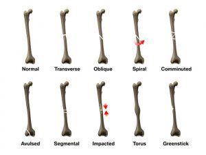 Treatment for Broken Bones and Fractures | Law Offices of Gary Martin & Associates, P.C.