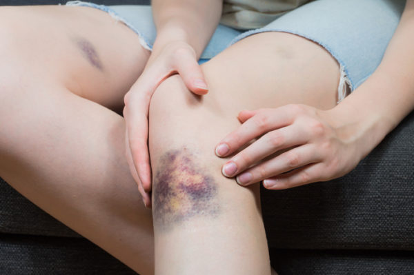 Bruising After a Car Accident  Law Offices of Gary Martin Hays &  Associates, P.C.