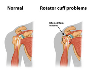 Rotator cuff injury