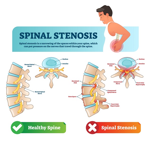 Name of spinal stenosis, symptoms and causes.